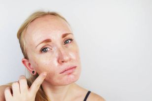 Home Remedies For Oily Skin That Work Well